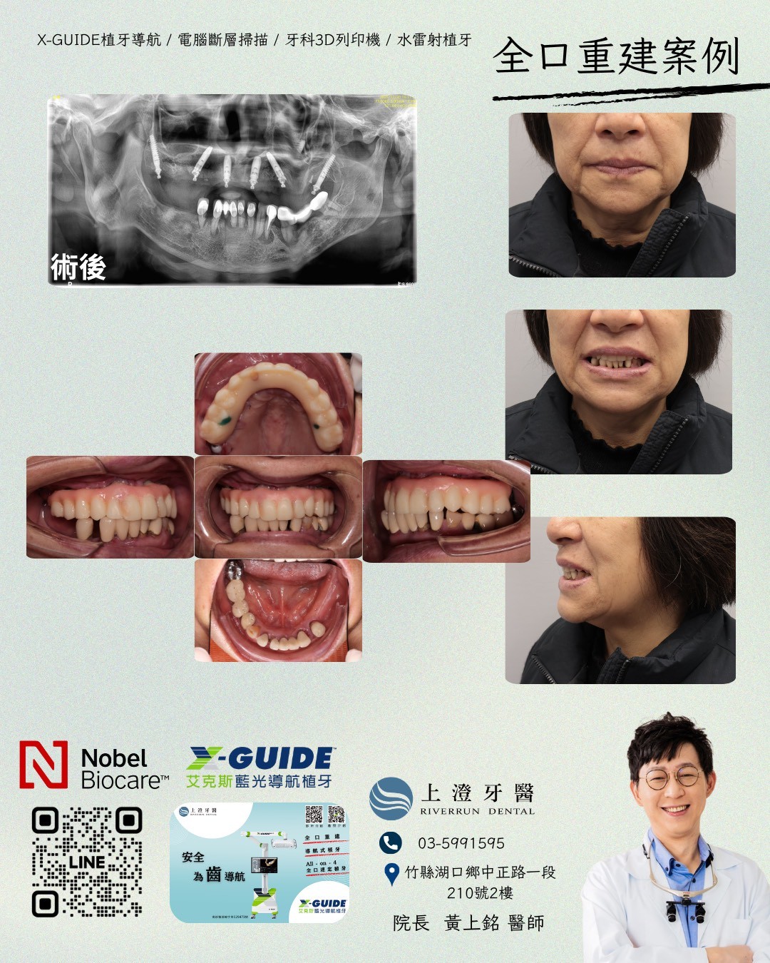 桃園All on 4/6案例