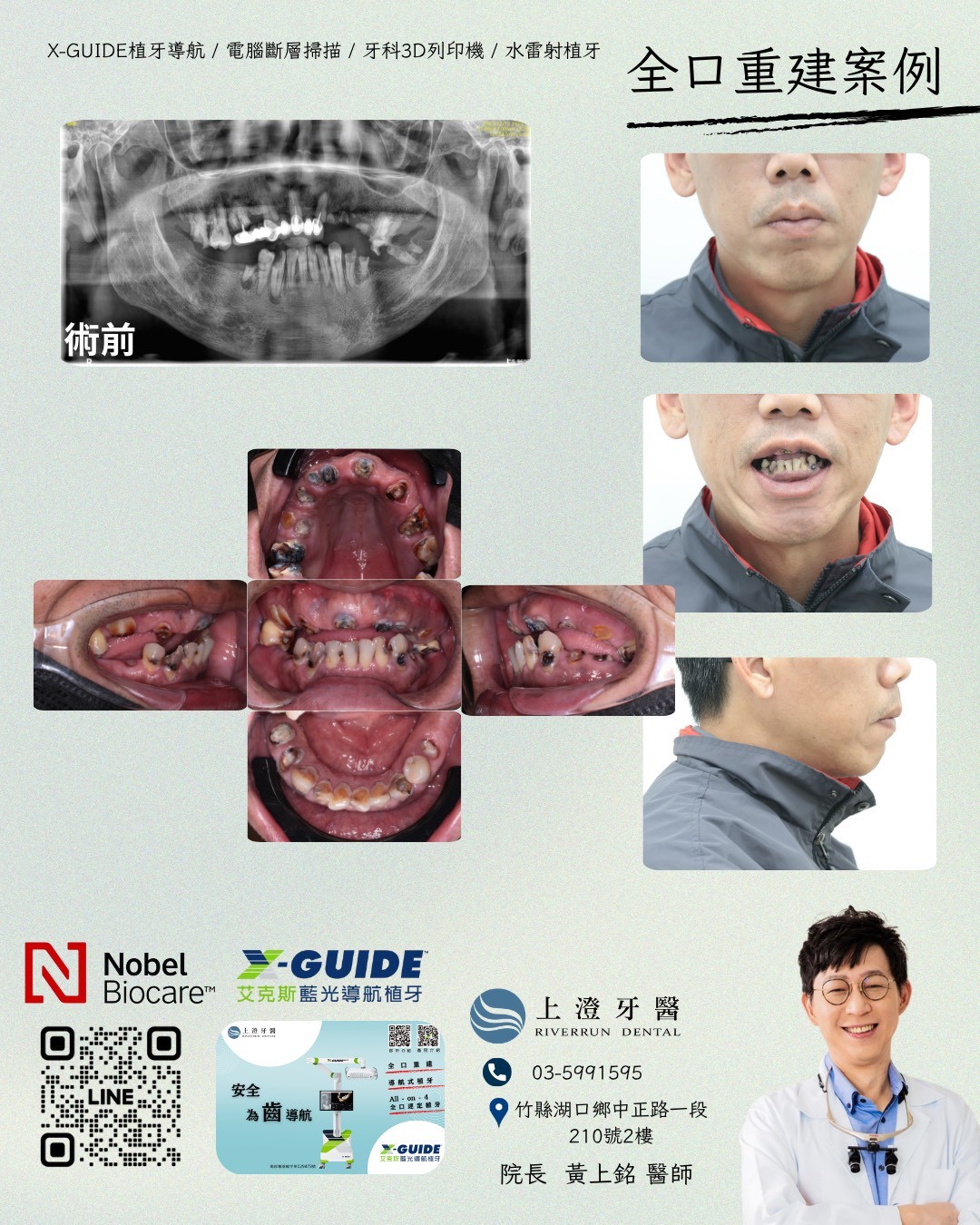 桃園All on 4/6案例