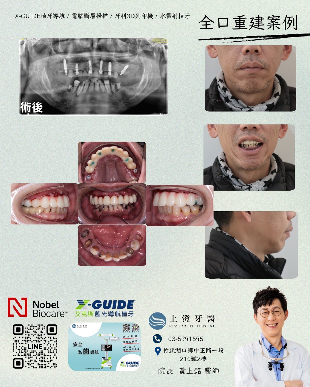 桃園All on 4/6案例