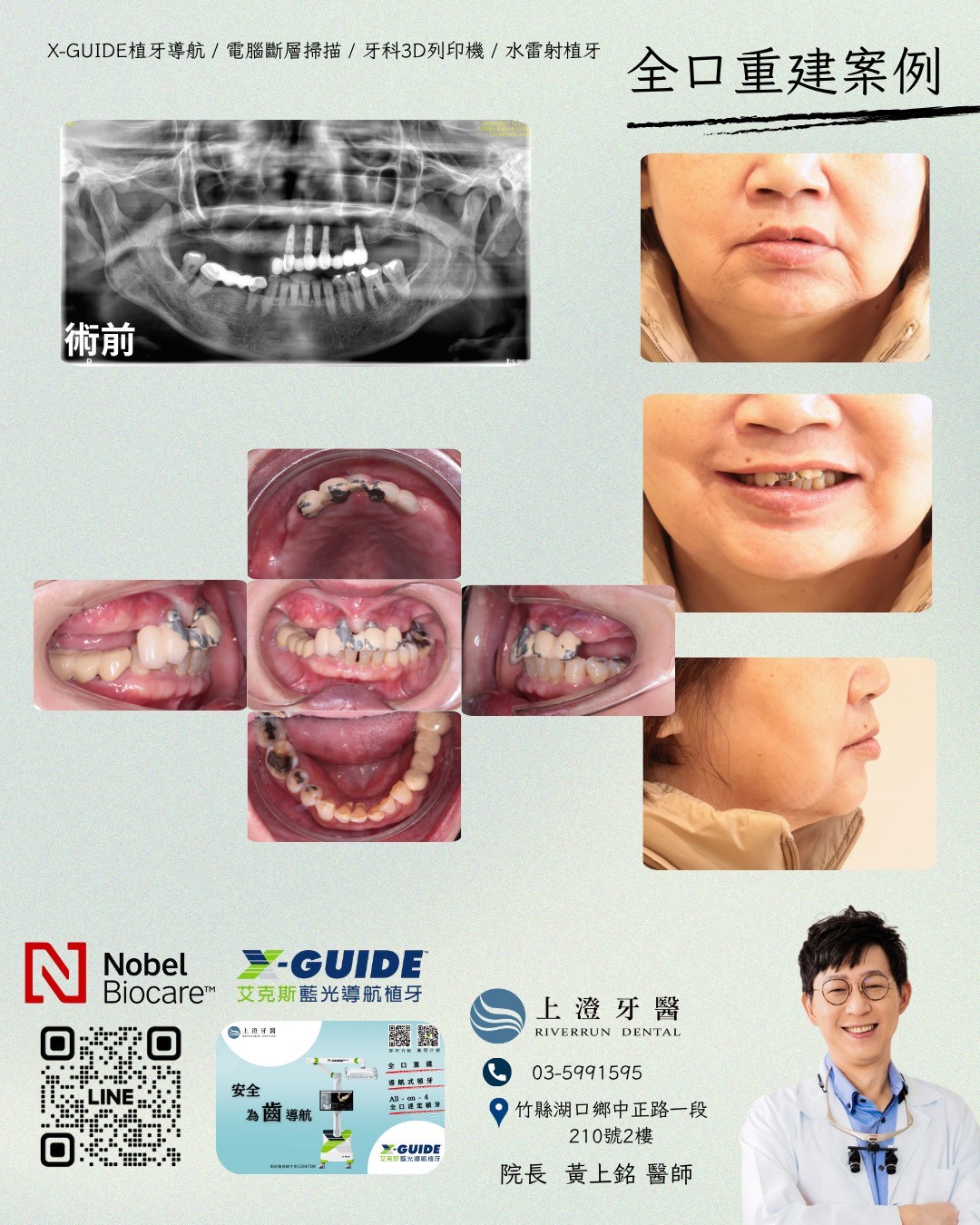 桃園All on 4/6案例