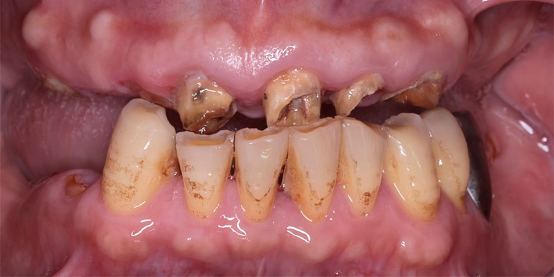 全口重建 All-on-4/6 介紹 全口重建 All-on-4/6 介紹