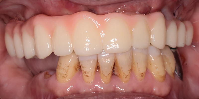 全口重建 All-on-4/6 介紹 全口重建 All-on-4/6 介紹