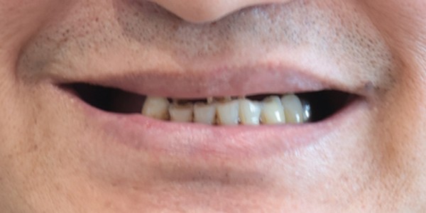 全口重建 All-on-4/6 介紹 全口重建 All-on-4/6 介紹