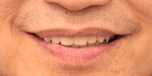 全口重建 All-on-4/6 介紹 全口重建 All-on-4/6 介紹