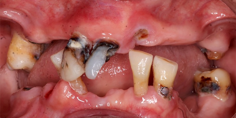 全口重建 All-on-4/6 介紹 全口重建 All-on-4/6 介紹