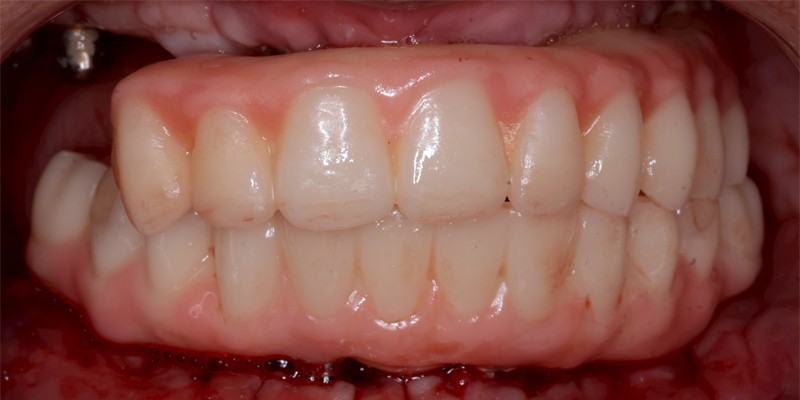 全口重建 All-on-4/6 介紹 全口重建 All-on-4/6 介紹