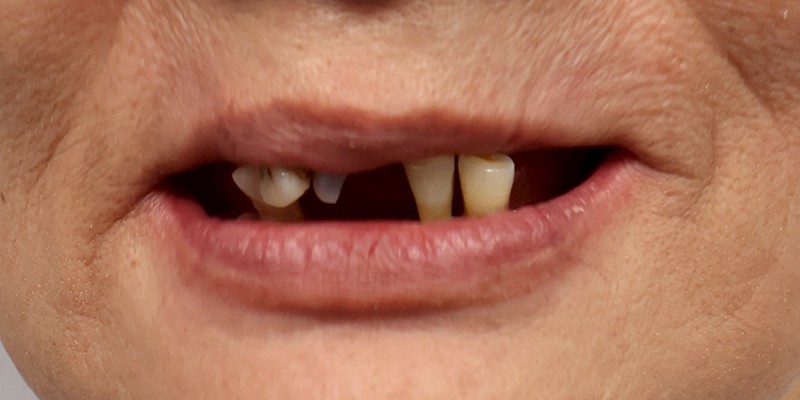 全口重建 All-on-4/6 介紹 全口重建 All-on-4/6 介紹