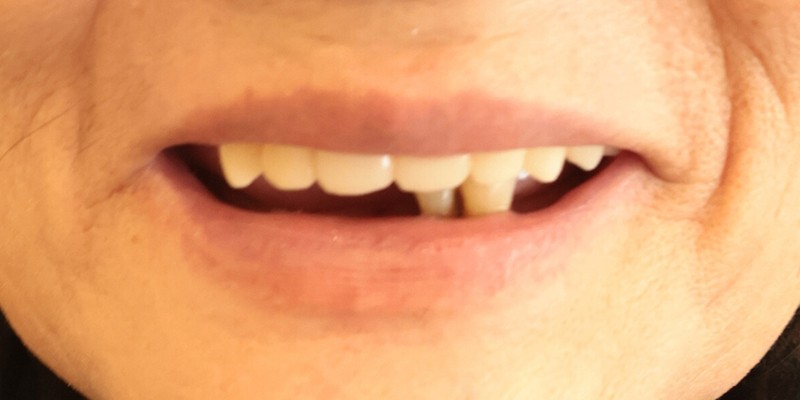 全口重建 All-on-4/6 介紹 全口重建 All-on-4/6 介紹