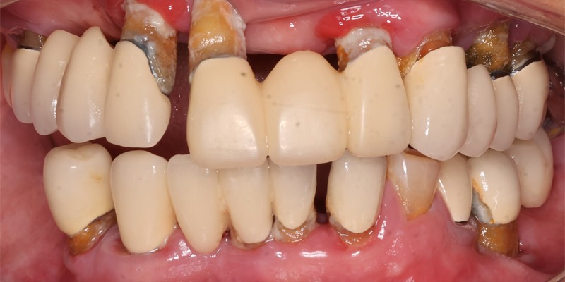 全口重建 All-on-4/6 介紹 全口重建 All-on-4/6 介紹