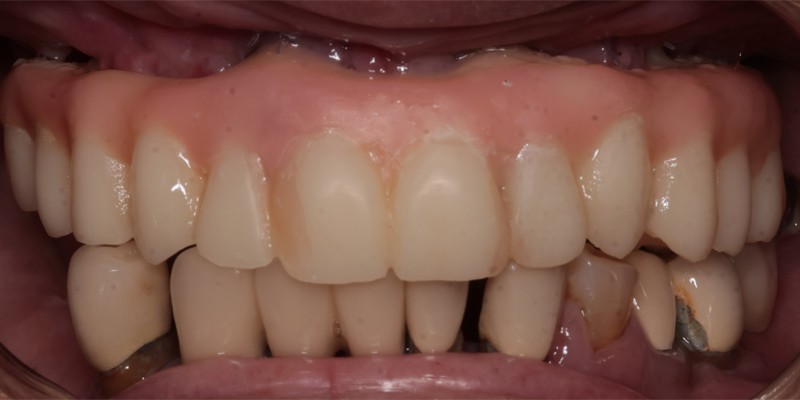 全口重建 All-on-4/6 介紹 全口重建 All-on-4/6 介紹