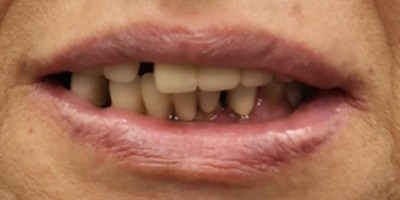 全口重建 All-on-4/6 介紹 全口重建 All-on-4/6 介紹