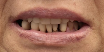 全口重建 All-on-4/6 介紹 全口重建 All-on-4/6 介紹