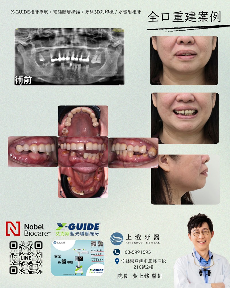 桃園All on 4/6案例
