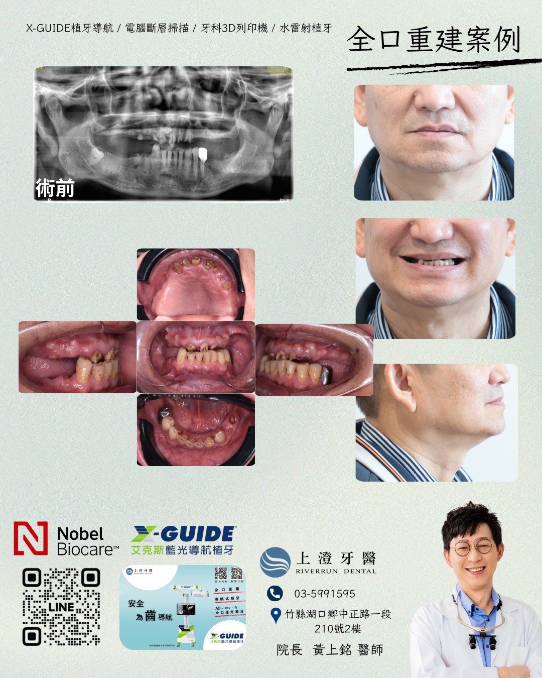 桃園All on 4/6案例