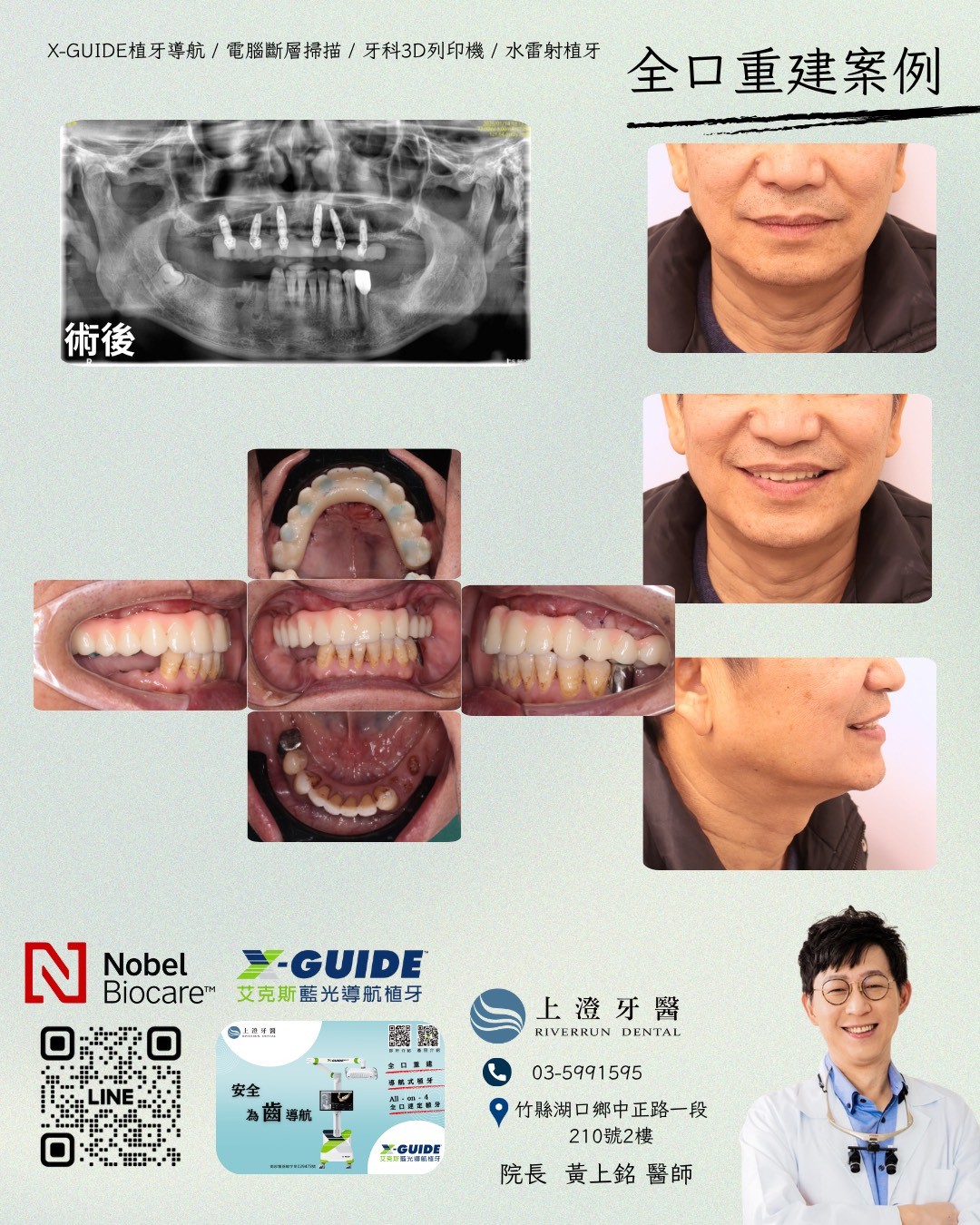 桃園All on 4/6案例