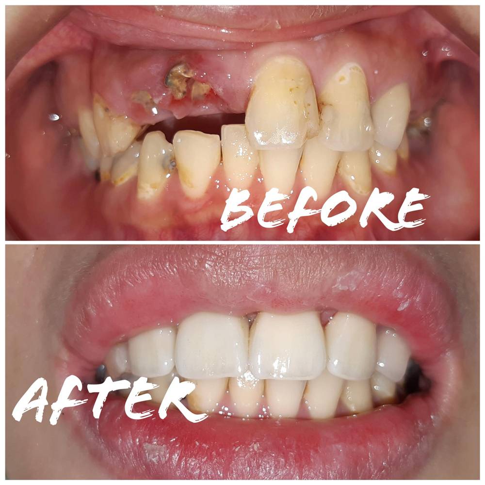 美學植牙(微笑曲線)