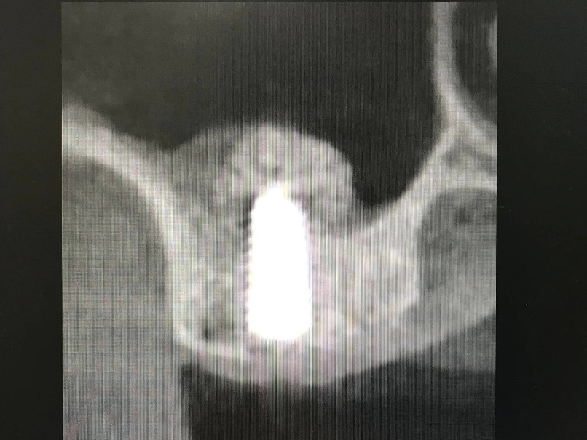 植牙手術很可怕嗎？