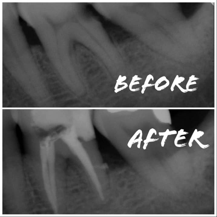 根管專科(治療方式)