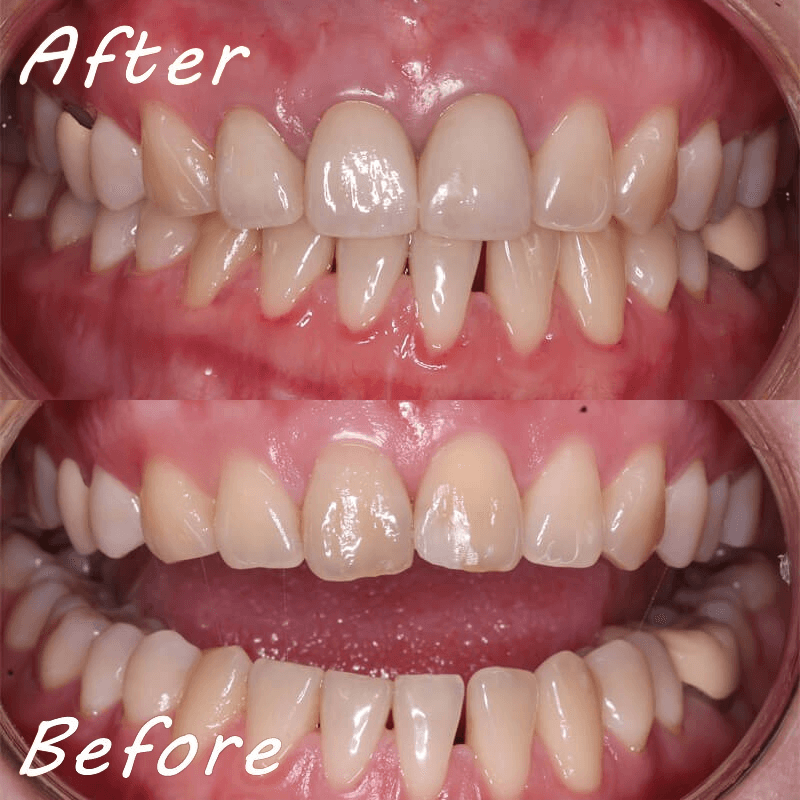 前牙美學-全瓷冠案例