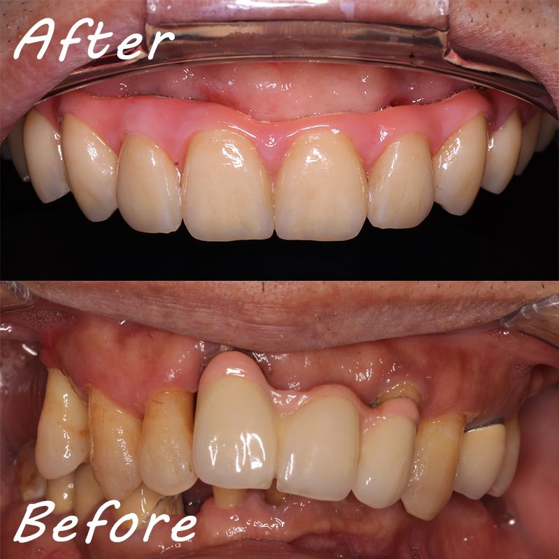 全口重建 All-on-4/6 介紹